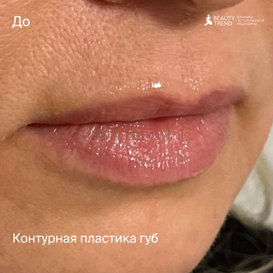 Контурная пластика губ - до 1